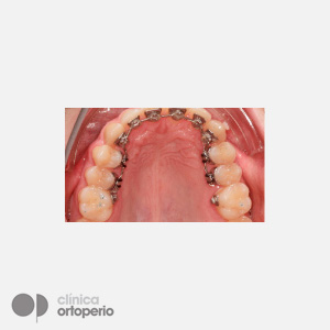 Ortodoncia Lingual WIN|Clínica Dental Ortoperio