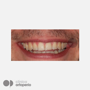 Ortodoncia Lingual WIN|Clínica Dental Ortoperio