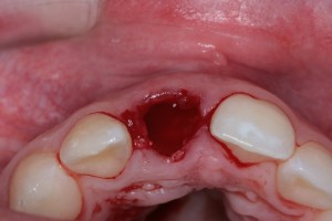 Extracción de diente con quiste y colocación de implante inmediato|Clínica Dental Ortoperio