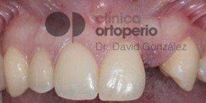 Agenesia de incisivo lateral (cuando no sale el diente) y rehabilitación del espacio con un implante|Clínica Dental Ortoperio