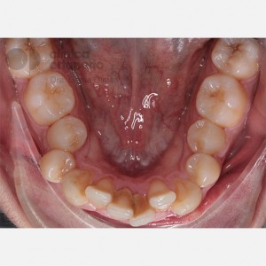 Apiñamiento severo. Ortodoncia Lingual sin extracciones. Stripping|Clínica Dental Ortoperio