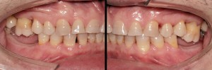 Intrusión de molares con microimplantes, sin aparato de ortodoncia.|Clínica Dental Ortoperio