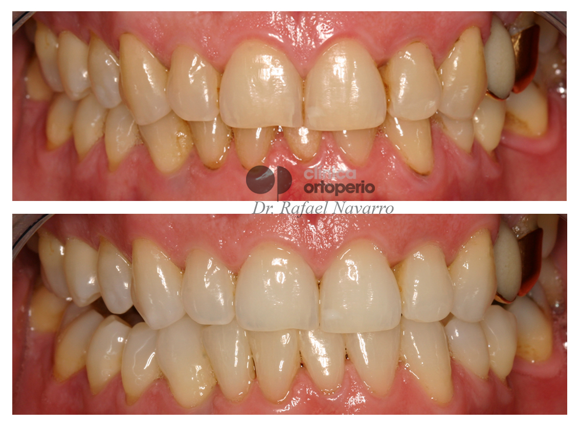 Blanqueamiento dental|Clínica Dental Ortoperio
