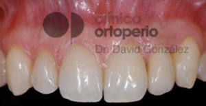 Lateral incisor agenesis (the tooth does not come out) and rehabilitation of the space with an implant|Clínica Dental Ortoperio