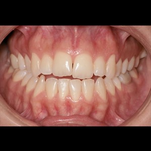 Lingual Orthodontics. Treatment of complex malocclusion class III and open bite in adult patient|Clínica Dental Ortoperio