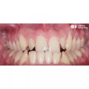 Orthodontic treatment. Class III, open bite, crossbite, overcrowding, receding gums. Treatment by gum graft, corticotomy and bone graft, and orthodontic treatment with skeletal anchorage|Clínica Dental Ortoperio