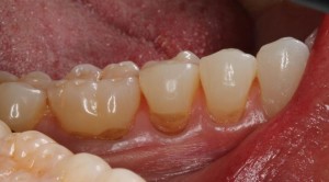 Restoration of caries in the neck of premolars and a molar with composite veneers|Clínica Dental Ortoperio