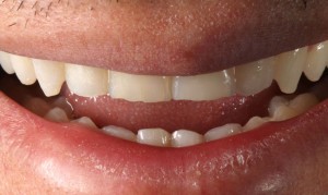 Restoration of incisors and upper canines wear with composite veneers|Clínica Dental Ortoperio