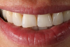 Restoration of incisors and upper canines wear with composite veneers|Clínica Dental Ortoperio
