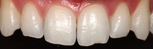 Incisors and upper canines restoration with composite veneers|Clínica Dental Ortoperio
