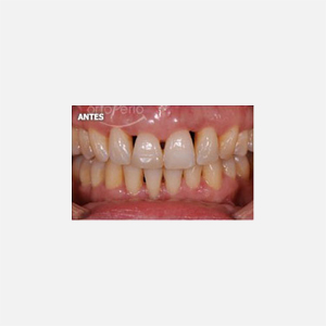 Aggressive periodontitis|Clínica Dental Ortoperio