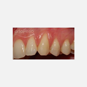 Multiple recessions in upper teeth|Clínica Dental Ortoperio