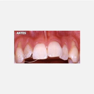 Multiple gingival recessions|Clínica Dental Ortoperio