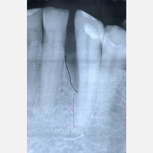 Caso de Regeneración de hueso perdido por periodontitis|Clínica Dental Ortoperio