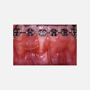 Retracción gingival en incisivo inferior|Clínica Dental Ortoperio