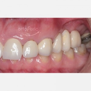 Bone and gum reconstruction to obtain papillae with implants on molars|Clínica Dental Ortoperio