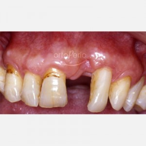 Paciente con Periodontitis avanzada: regeneración de hueso e implantes|Clínica Dental Ortoperio