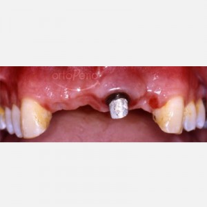 Bone and gum regeneration: Zirconium abutments and zirconium-porcelain crowns|Clínica Dental Ortoperio