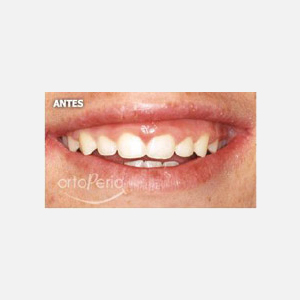 Sonrisa gingival|Clínica Dental Ortoperio