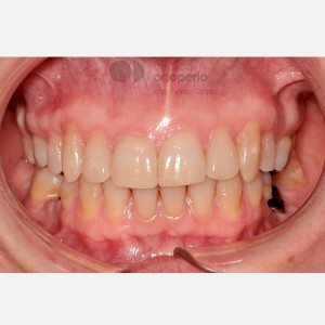 Lingual Orthodontics: Class II, extractions, micro-implants, implants|Clínica Dental Ortoperio
