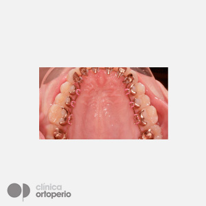 Lingual Orthodontics: Dental alignment and levelling through expansion to fill buccal corridors|Clínica Dental Ortoperio