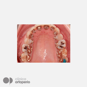 Lingual Orthodontics: Class II, extractions, micro-implants, implants|Clínica Dental Ortoperio