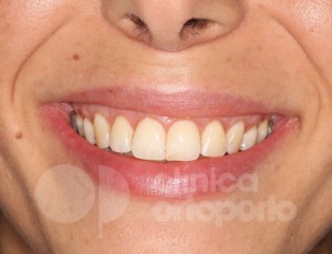 Ortodoncia lingual+Injerto de encía para solucionar un caso grave de retracción de encías (recesiones gingivales).|Clínica Dental Ortoperio