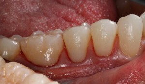 Restauración de caries en cuellos de premolares y molar con carillas de composite|Clínica Dental Ortoperio
