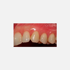 Multiple recessions in upper teeth|Clínica Dental Ortoperio