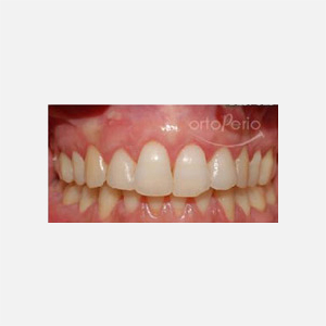 Multiple gingival recession (tunnel graft)|Clínica Dental Ortoperio