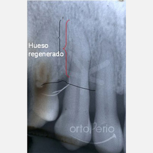 Regeneration of bone loss caused by periodontitis|Clínica Dental Ortoperio