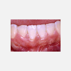Receding gums in lower incisor|Clínica Dental Ortoperio