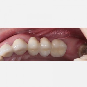 Reconstrucción de hueso y encía para conseguir papilas con implantes en molares|Clínica Dental Ortoperio