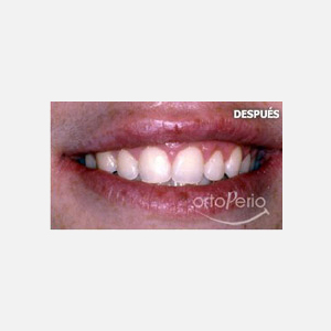 Gingival smile|Clínica Dental Ortoperio