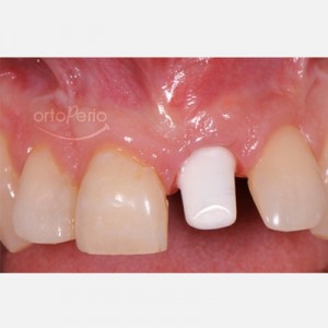 Regeneración de hueso + implante (diente pérdido por fractura)|Clínica Dental Ortoperio