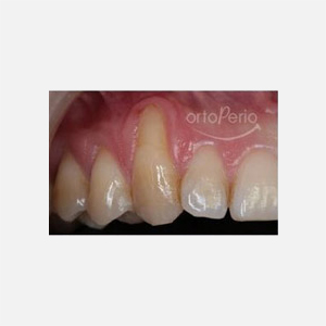 Young woman with serious gingival recessions affecting her upper canines|Clínica Dental Ortoperio