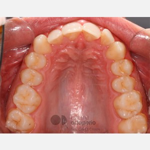 Clase II Subdivisión con apiñamiento|Clínica Dental Ortoperio