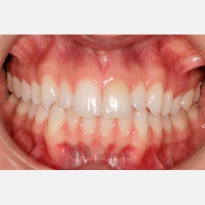 Ortodoncia Lingual: Alineación y nivelación mediante expansión para rellenar corredores bucales|Clínica Dental Ortoperio