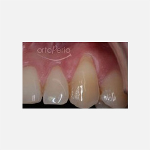 Young woman with serious gingival recessions affecting her upper canines|Clínica Dental Ortoperio