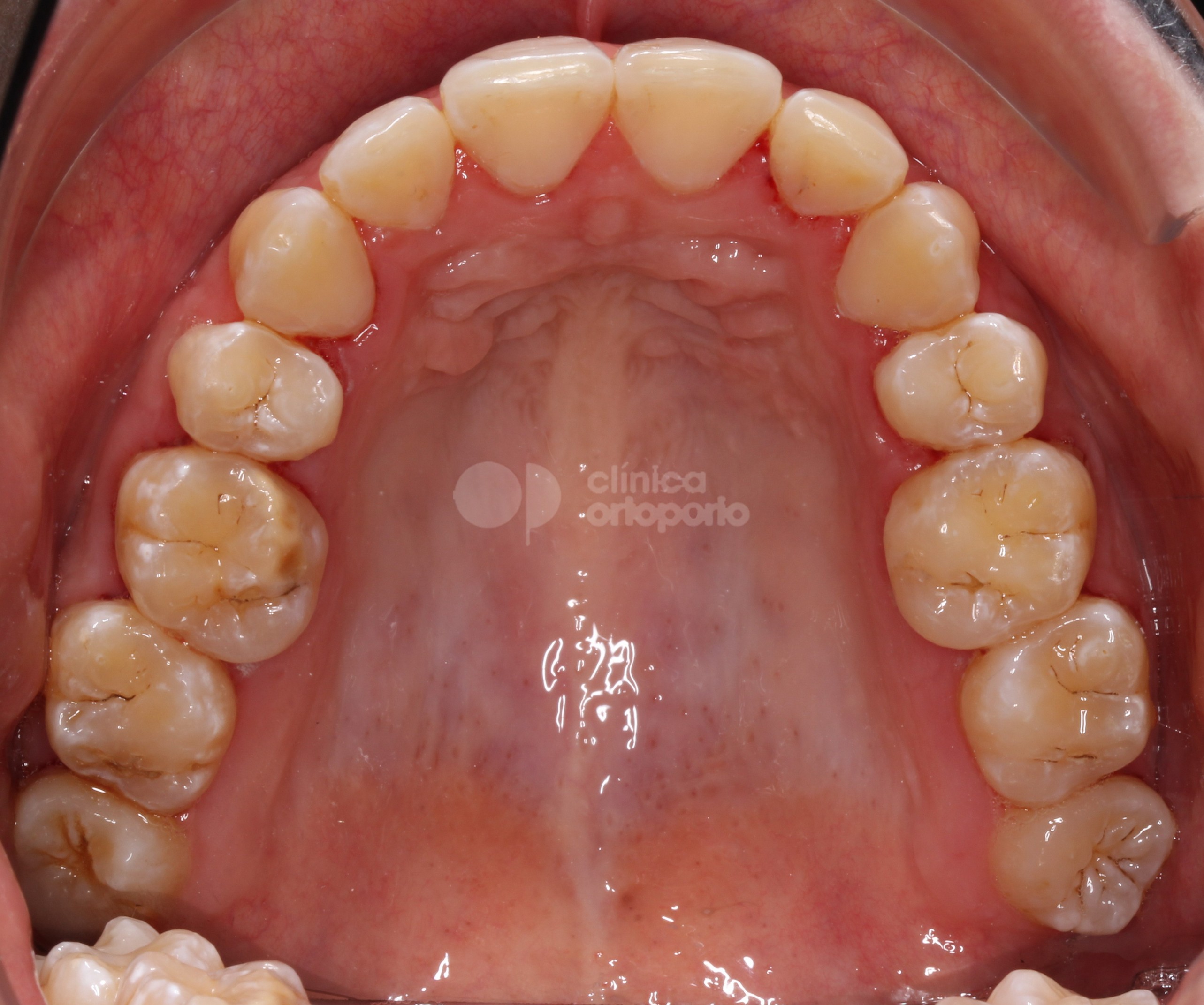 Ortodoncia lingual+Injerto de encía para solucionar un caso grave de retracción de encías (recesiones gingivales).|Clínica Dental Ortoperio