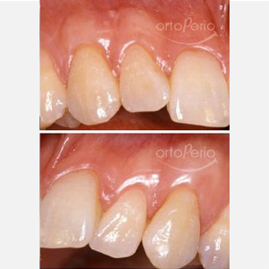 Multiple gingival recessions|Clínica Dental Ortoperio