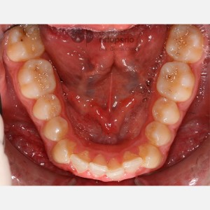 Clase II Subdivisión con apiñamiento|Clínica Dental Ortoperio