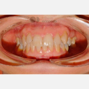 Ortodoncia Lingual: Clase II, extracciones, microimplantes, Implantes|Clínica Dental Ortoperio