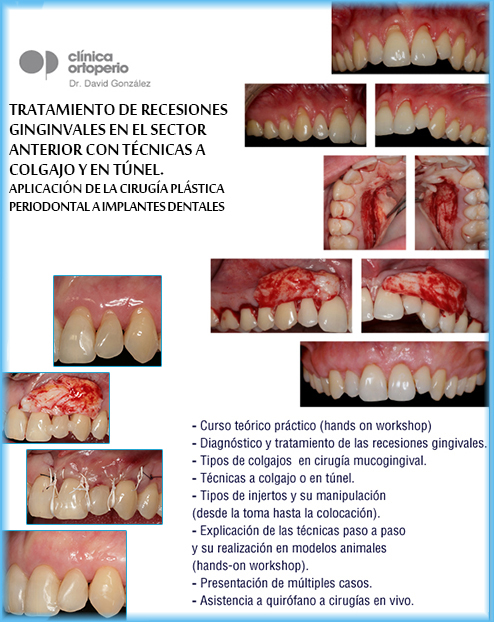 Tratamiento de recesiones gingivales en el sector anterior con técnicas a colgajo y en túnel.|Clínica Dental Ortoperio
