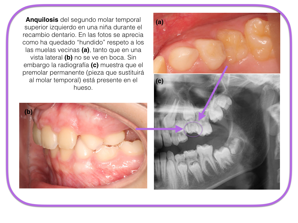 Anquilosis Dental 1