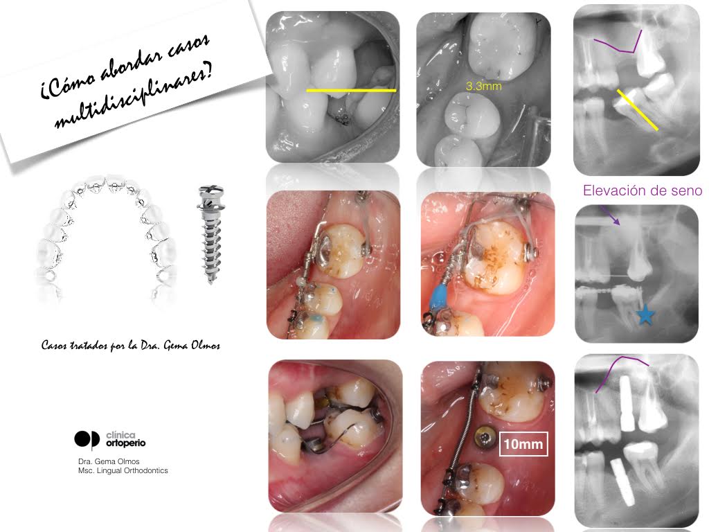 4ª Edición Curso Intensivo de Ortodoncia Lingual|Clínica Dental Ortoperio