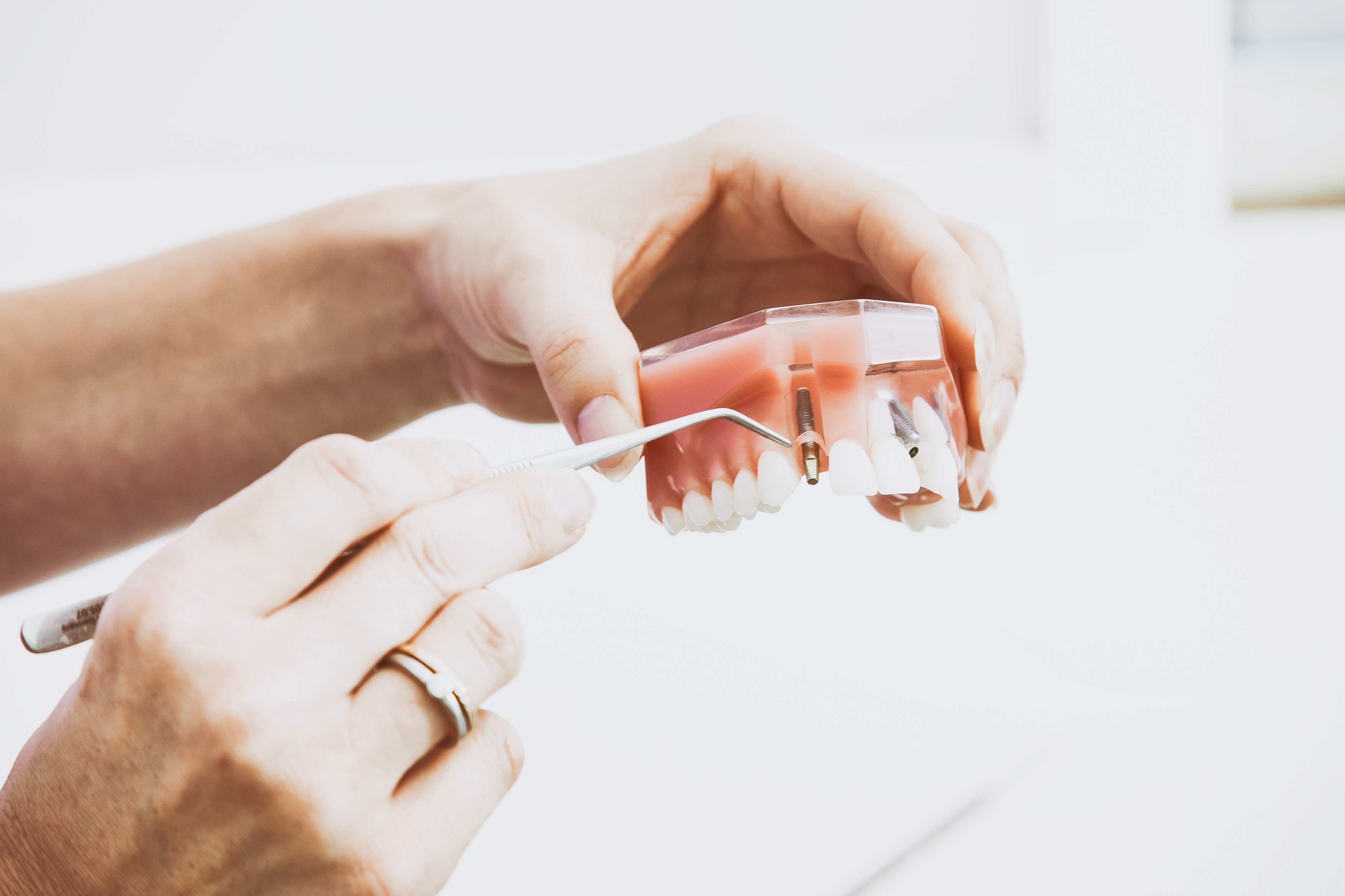 Algunas causas comunes de rechazo a un implante dental