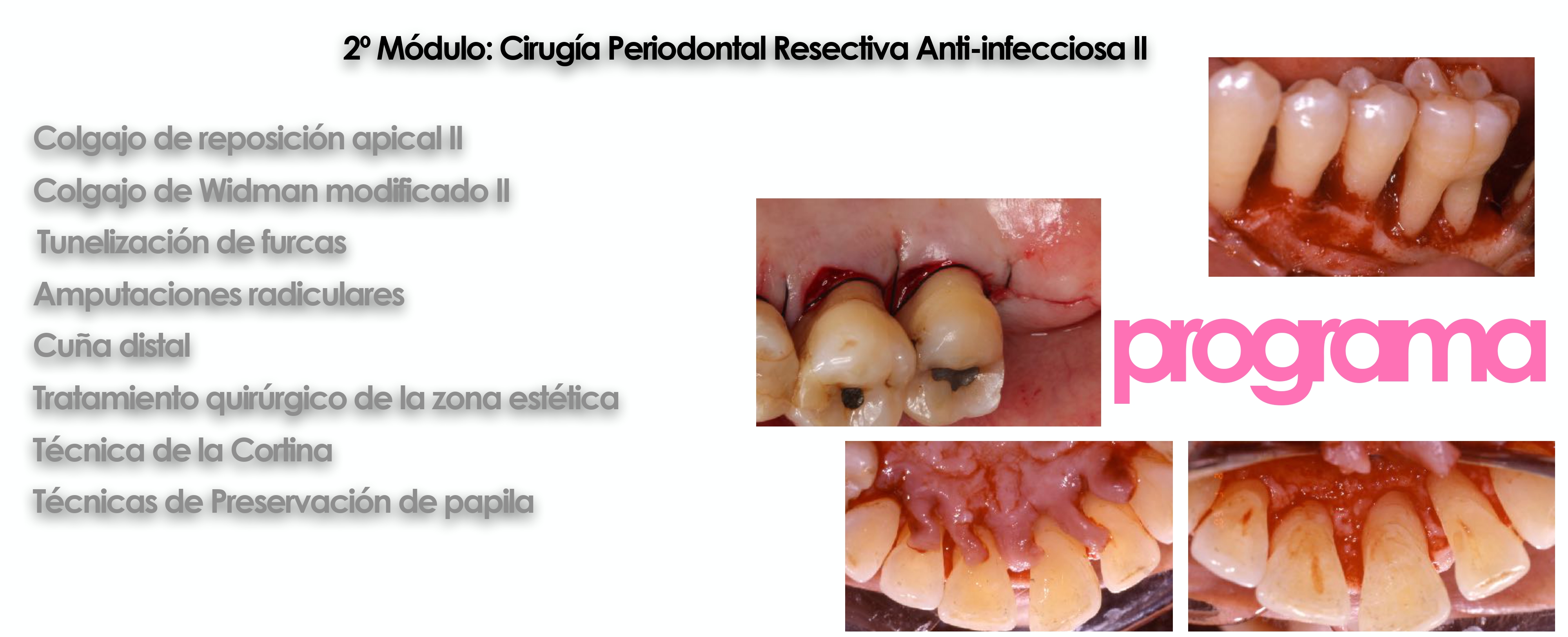 Curso cirugía periodontal e implantológica|Clínica Dental Ortoperio