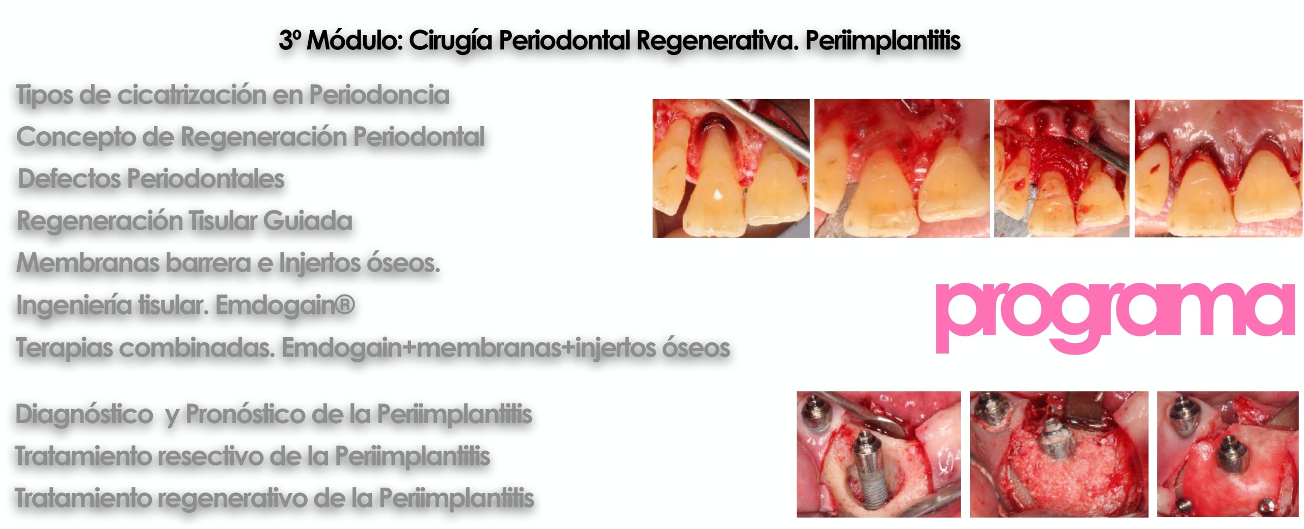 Curso cirugía periodontal e implantológica 2022|Clínica Dental Ortoperio