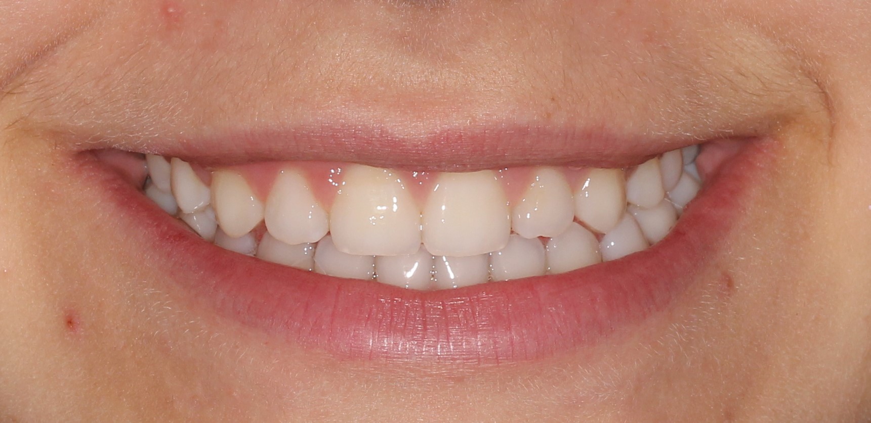 Ortodoncia Infantil. Ortopedia (Disyuntor y máscara facial) y Ortodoncia|Clínica Dental Ortoperio